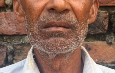 Budaun News: 11 ब्लॉकों में 1400 से डेंगू पीड़ित, विभाग में महज 89 मरीज ही दर्ज